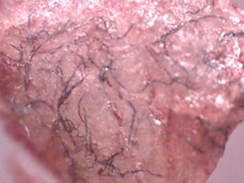 A severe skin condition of a patient suspecting Morgellons disease image photo picture