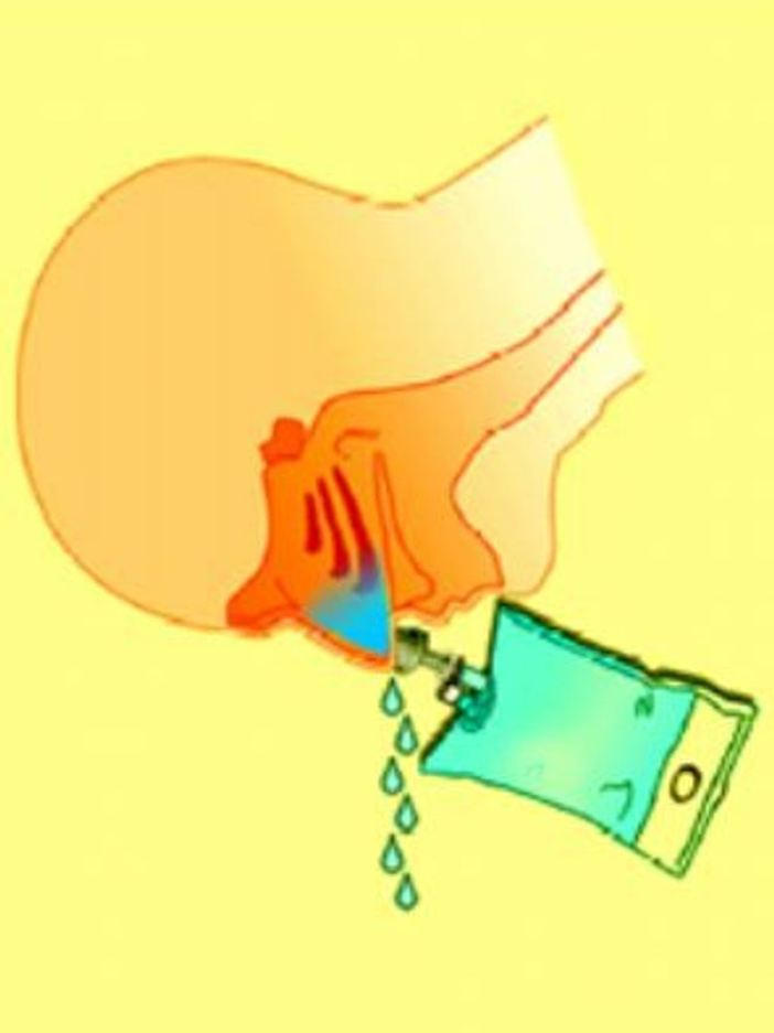 Rivolus set za izpiranje sinusov